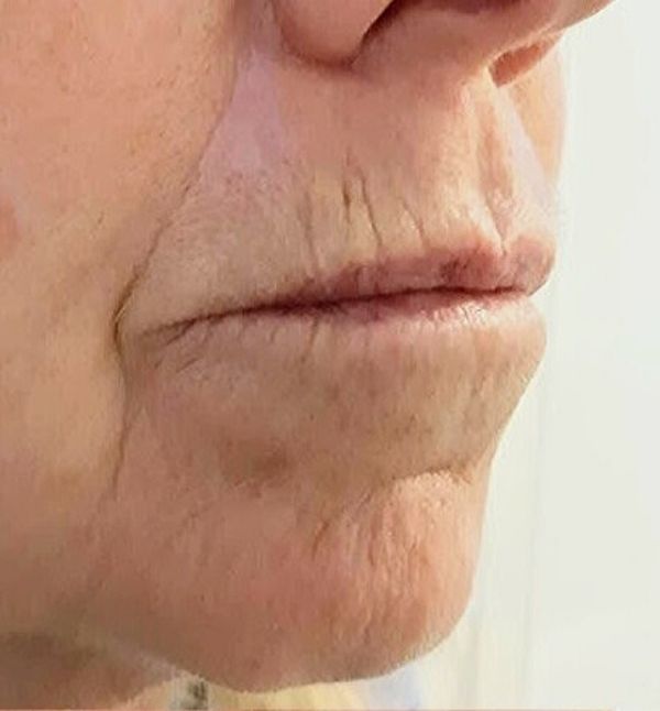 Before-Rejuvenecimiento