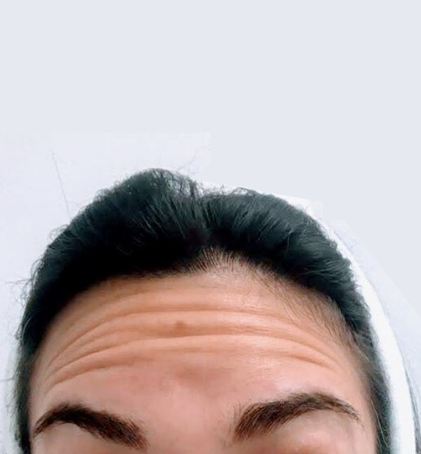 Before-Eliminación Arrugas