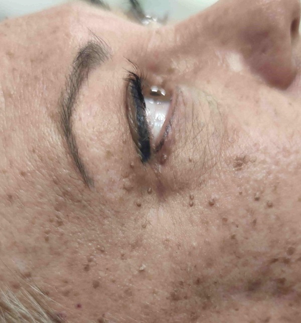 Before-Eliminación Verrugas Láser