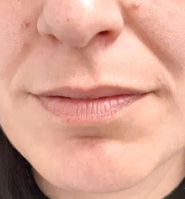 Before-Remodelación Labios