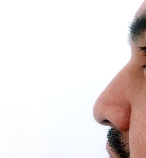 Before-Rinomodelación