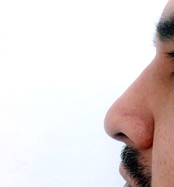 After-Rinomodelación