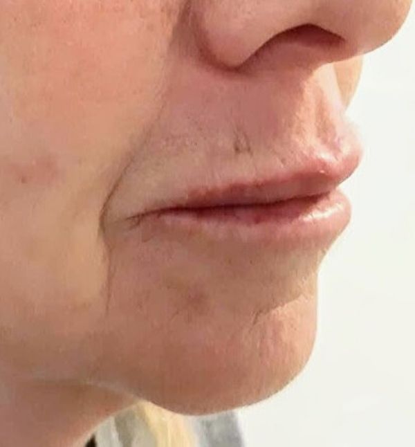 After-Rejuvenecimiento