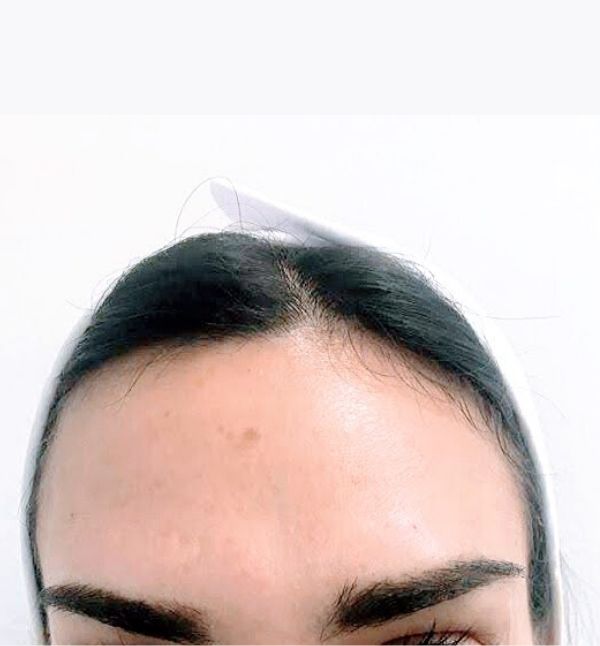 After-Eliminación Arrugas